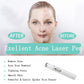 Blue Light Face Therapy Pen